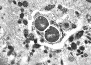M,44y. | unidentified cocci clin. dg. - granuloma venereum M,44y. | unidentified cocci clin. dg. - granuloma venereum